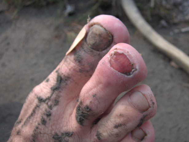 A fallen-off toenail, due to trauma incurred several weeks earlier during an Ironman. Such an issue is best addressed with a rubber toe cap or with a combination of tape and moleskin. Also, try to keep your feet clean, although that's hard when packrafting glacier-fed rivers in Alaska.